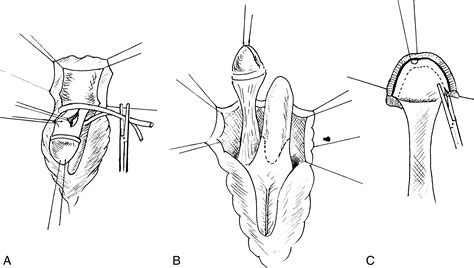 clitoris plastico|clitoroplasty definition.